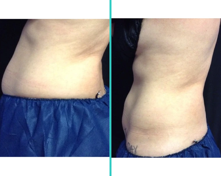 CoolSculpting 4.2