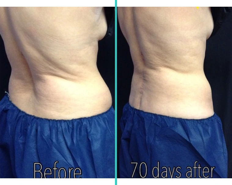 CoolSculpting 4