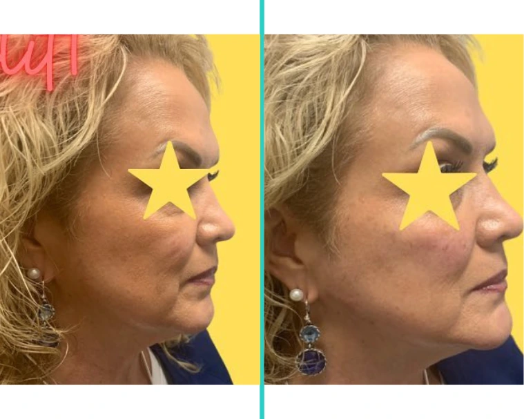 Non-Surgical Facelift with Dermal Filler 1.2