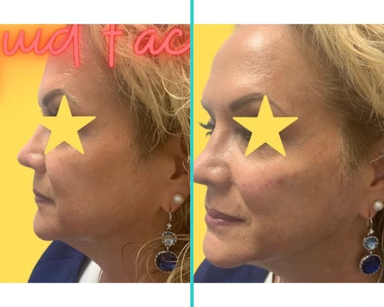 Non-Surgical Facelift with Dermal Filler 1
