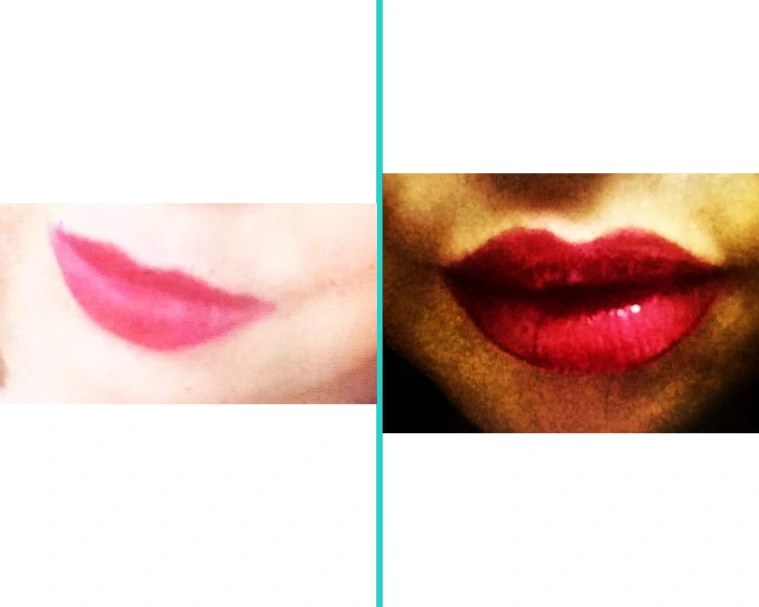 Restylane lip filler