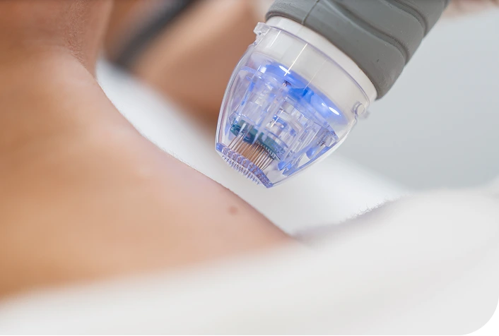 What Is RF Microneedling In Starke, FL Banner