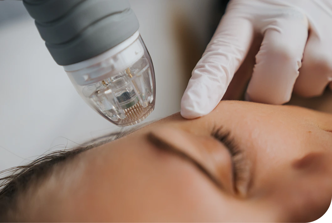 RF Microneedling in Starke, FL Banner